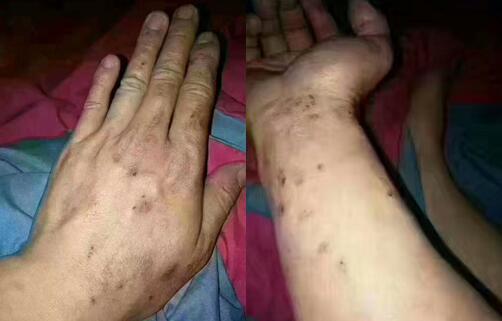 劣質真瓷膠后果